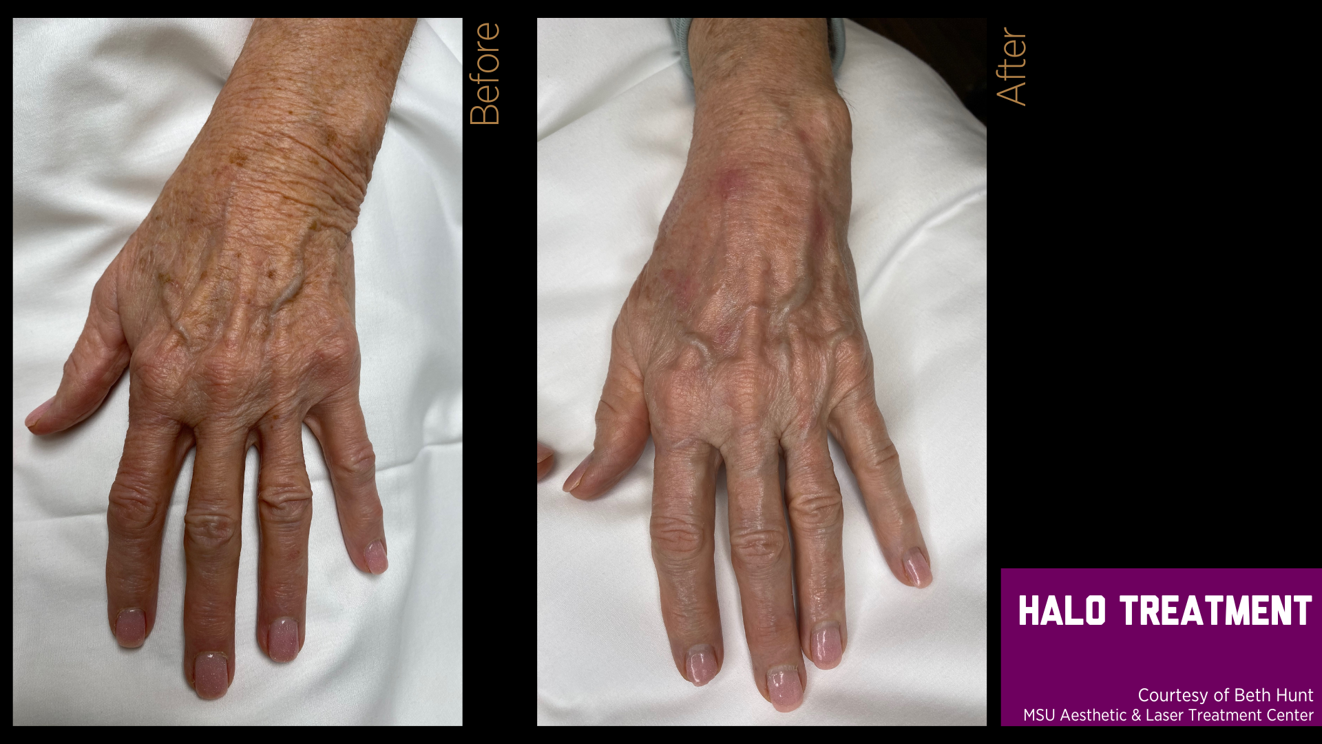 before and after of a halo treatment