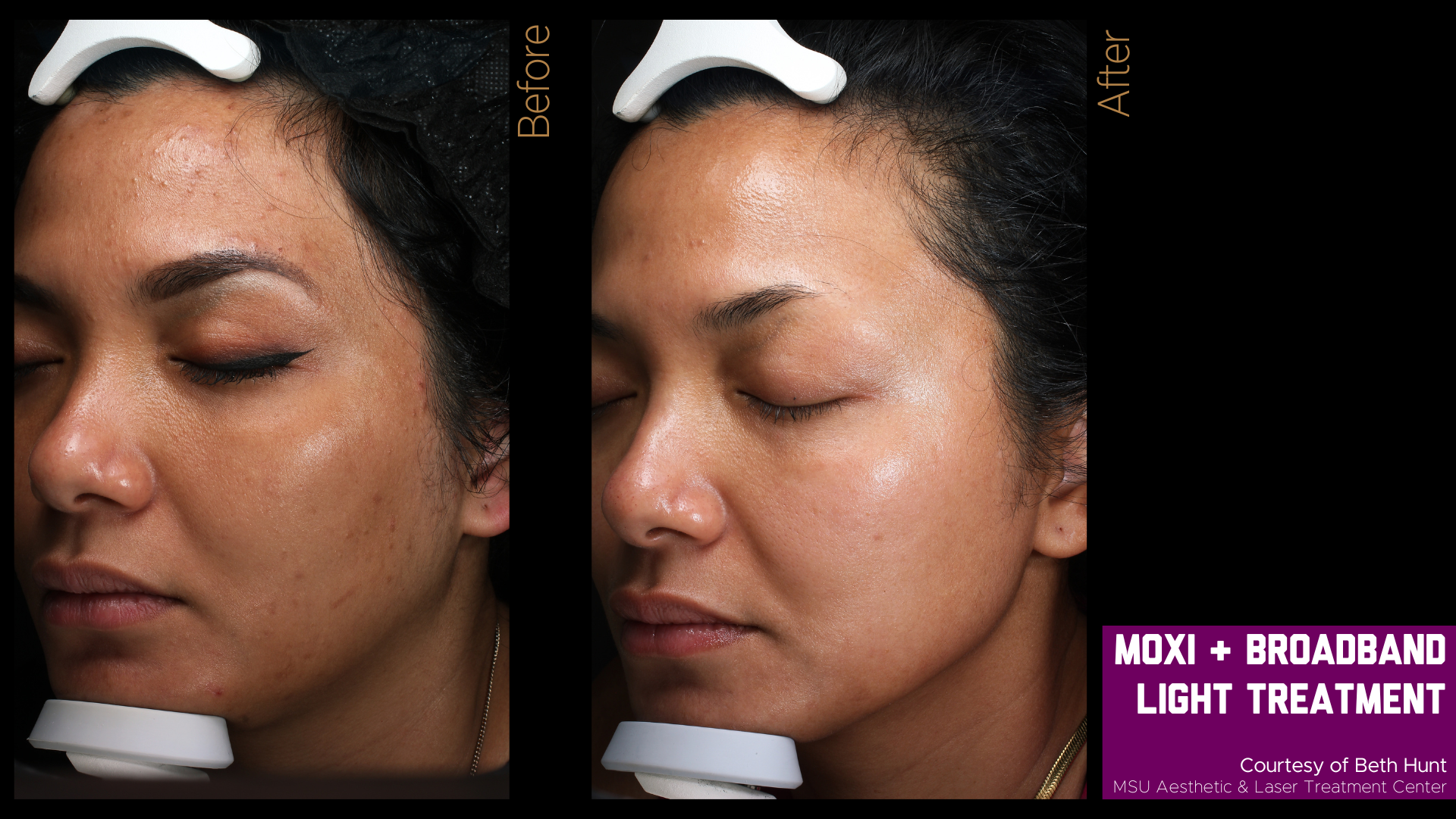 before and after of a moxi treatment