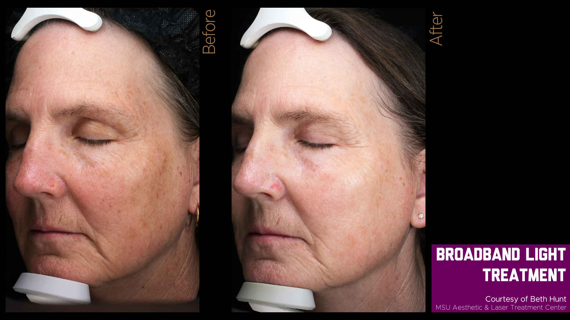 before and after photos of a broadband light treatment