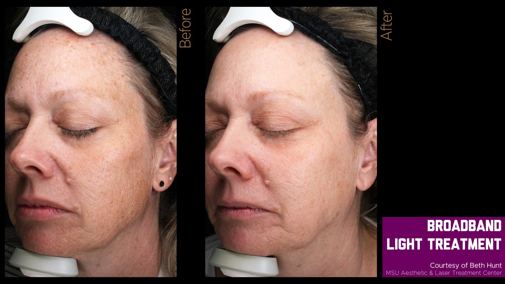 before and after photos of a broadband light treatment