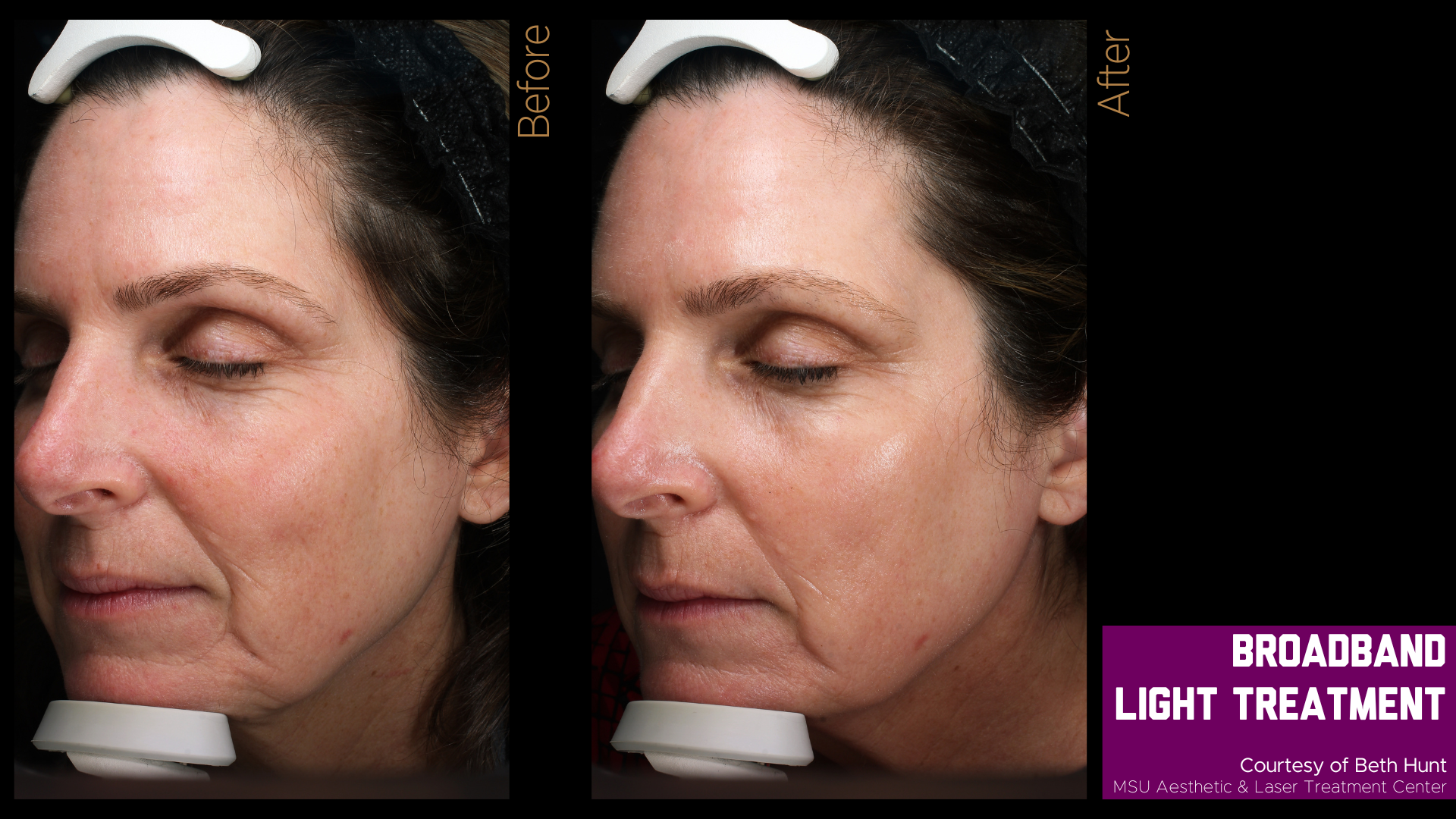 before and after photos of a broadband light treatment